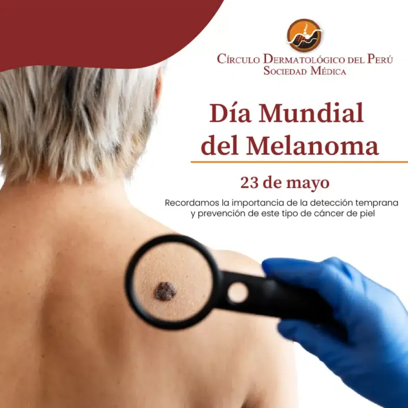 Día Mundial del Melanoma